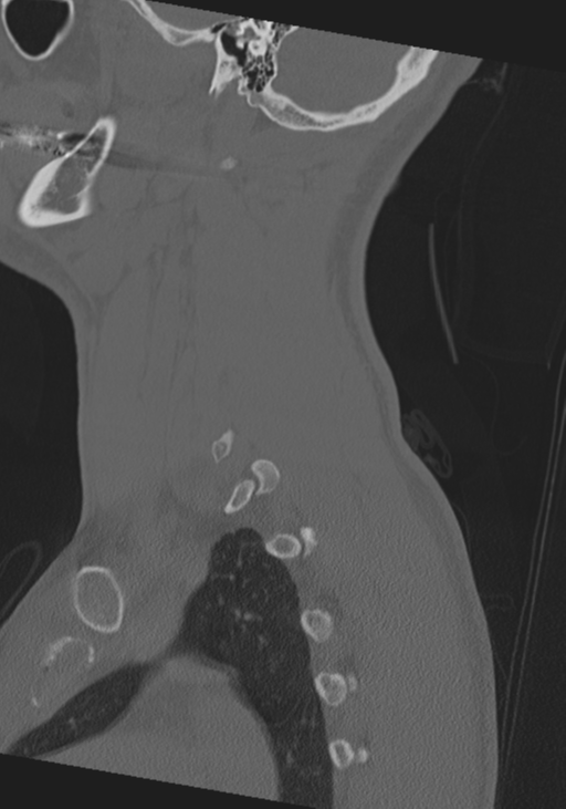 Cervical intercalary bone (Radiopaedia 35211-36748 Sagittal bone window 15).png