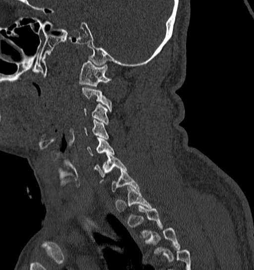 File:Cervical spine trauma with tear drop fracture and perched facet joint (Radiopaedia 53989-60127 Sagittal bone window 38).jpg