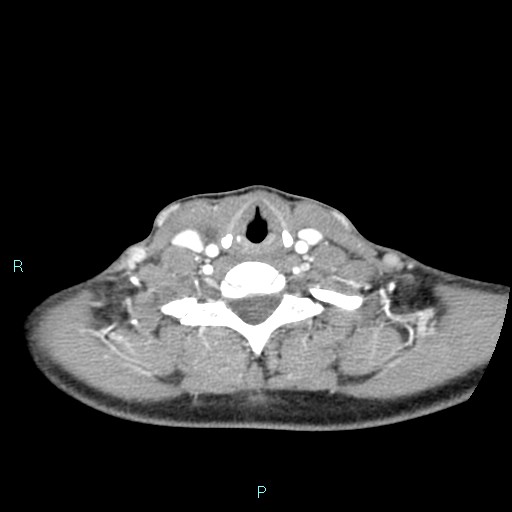 Cervical thymic cyst (Radiopaedia 88632-105335 B 42).jpg