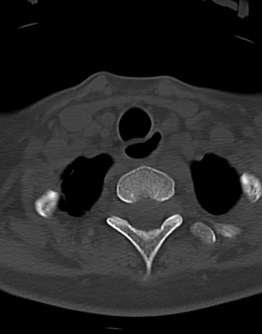 Cervical tuberculous spondylitis (Radiopaedia 39149-41365 Axial bone window 47).png