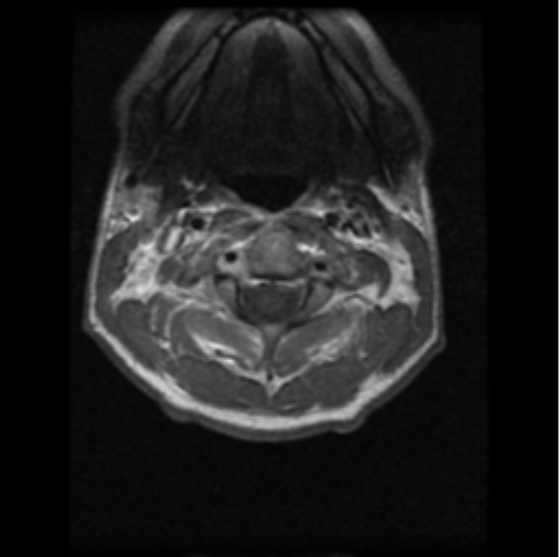 File:Cervical vertebrae metastasis (Radiopaedia 78814-91667 Axial T1 C+ 20).png