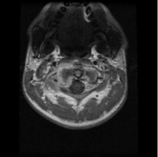 File:Cervical vertebrae metastasis (Radiopaedia 78814-91667 Axial T1 C+ 23).png