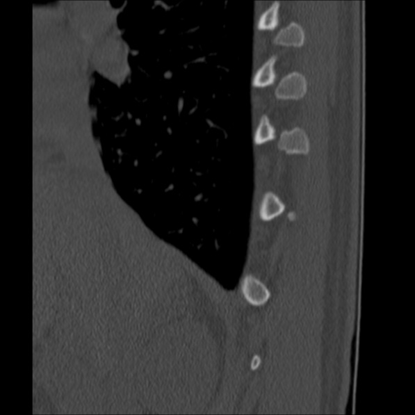 Chance fracture (Radiopaedia 36521-38081 Sagittal bone window 4).jpg