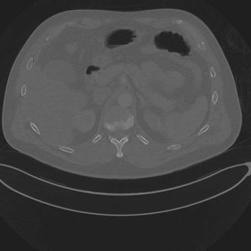 Chest multitrauma - aortic injury (Radiopaedia 34708-36147 Axial bone window 306).png