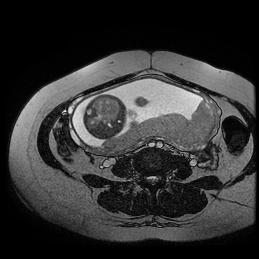 Chiari II malformation - fetal MRI (Radiopaedia 68099-77581 Axial Fiesta 13).jpg