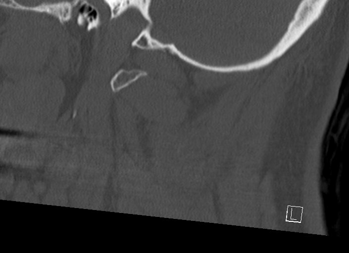 Chiari I malformation with a symptomatic syrinx of the posterolateral medulla oblongata (Radiopaedia 42573-45707 A 47).jpg