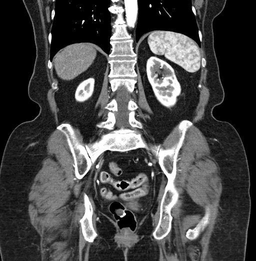 File:Cholecystoduodenal fistula due to calculous cholecystitis with gallstone migration (Radiopaedia 86875-103077 B 33).jpg