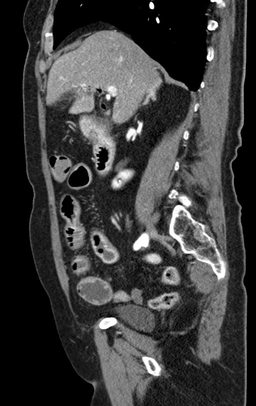 Cholecystoduodenal fistula due to calculous cholecystitis with gallstone migration (Radiopaedia 86875-103077 C 39).jpg