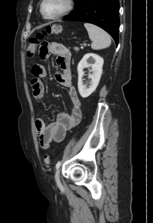 Cholecystoduodenal fistula due to calculous cholecystitis with gallstone migration (Radiopaedia 86875-103077 F 15).jpg