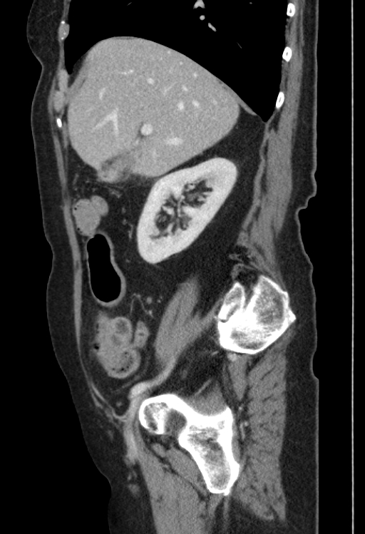 Cholecystoduodenal fistula due to calculous cholecystitis with gallstone migration (Radiopaedia 86875-103077 F 42).jpg