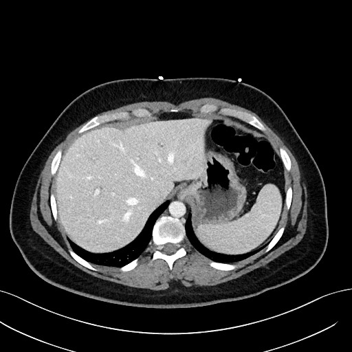 File:Choledocholithiasis after recent cholecystectomy (Radiopaedia 60929-68737 Axial 53).jpg