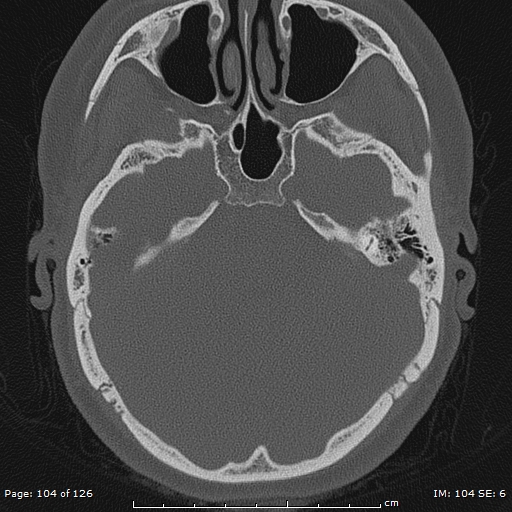 Cholesteatoma - external auditory canal (Radiopaedia 88452-105096 Axial bone window 67).jpg