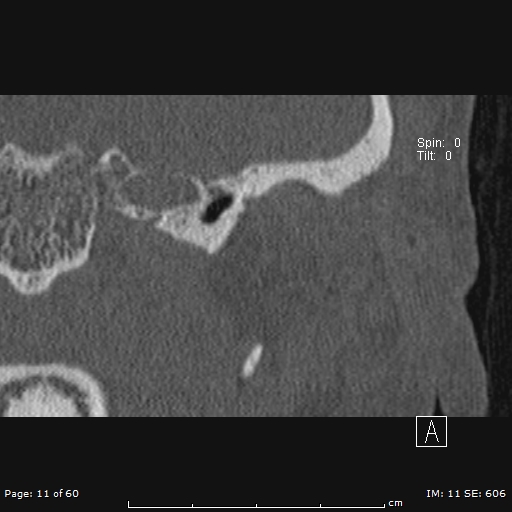 Cholesteatoma - external auditory canal (Radiopaedia 88452-105096 Coronal bone window 11).jpg