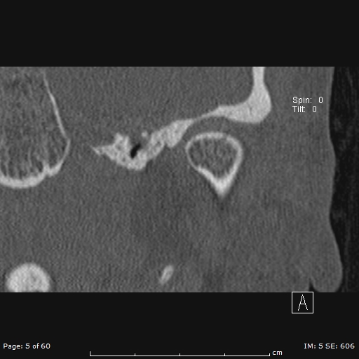 Cholesteatoma - external auditory canal (Radiopaedia 88452-105096 Coronal bone window 5).jpg