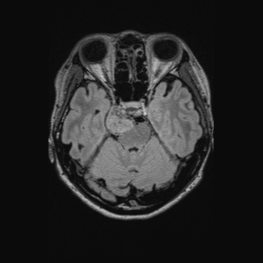 Chondrosarcoma (Radiopaedia 41937-44939 Axial FLAIR 48).png