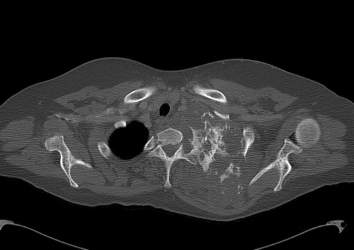 Chondrosarcoma - chest wall (Radiopaedia 65192-74199 Axial bone window 18).jpg