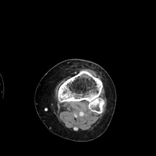 File:Chondrosarcoma - femur (Radiopaedia 64187-72954 Axial with contrast 70).jpg