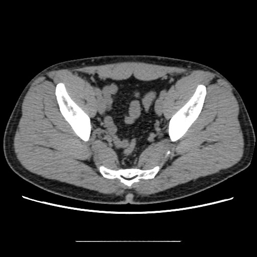 Chondrosarcoma of iliac wing (Radiopaedia 63861-72599 Axial non-contrast 79).jpg
