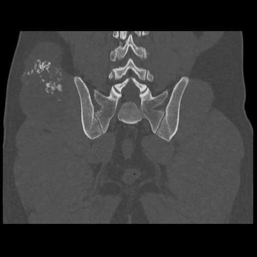 Chondrosarcoma of iliac wing (Radiopaedia 63861-72599 Coronal bone window 84).jpg