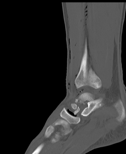 Chopart fracture (Radiopaedia 35347-36851 Sagittal bone window 37).jpg