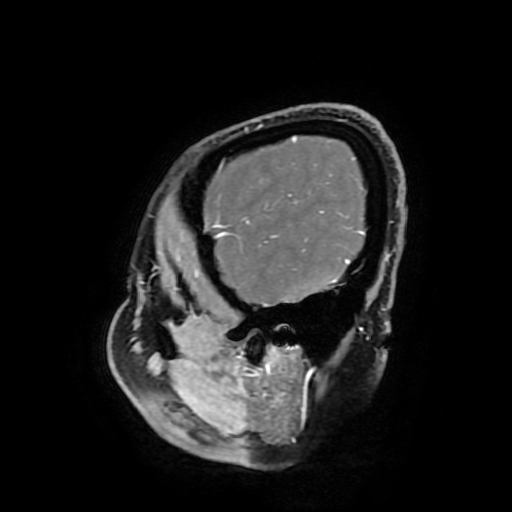 Chordoid glioma of third ventricle (Radiopaedia 91612-109340 F 179).jpg