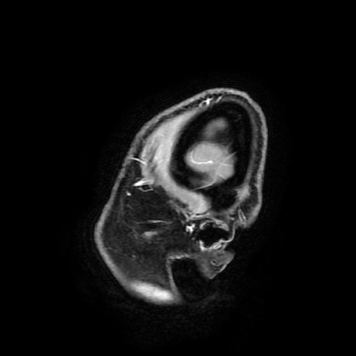 Chordoid glioma of third ventricle (Radiopaedia 91612-109340 F 22).jpg