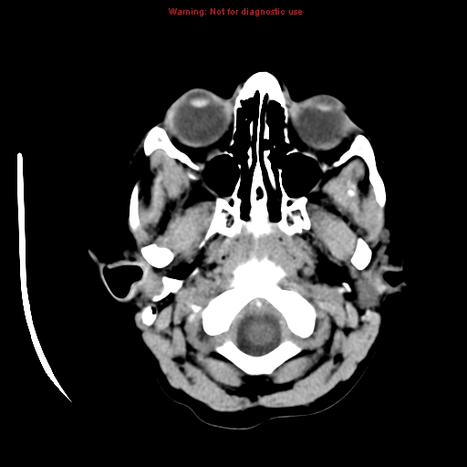 File:Choroid plexus carcinoma - recurrent (Radiopaedia 8330-9168 Axial non-contrast 1).jpg
