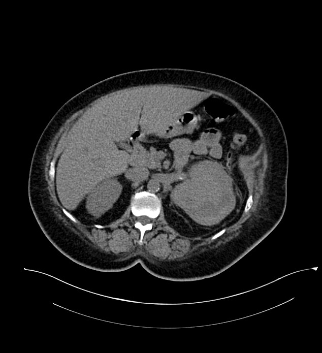 Chromophobe renal cell carcinoma (Radiopaedia 84239-99519 Axial non-contrast 65).jpg