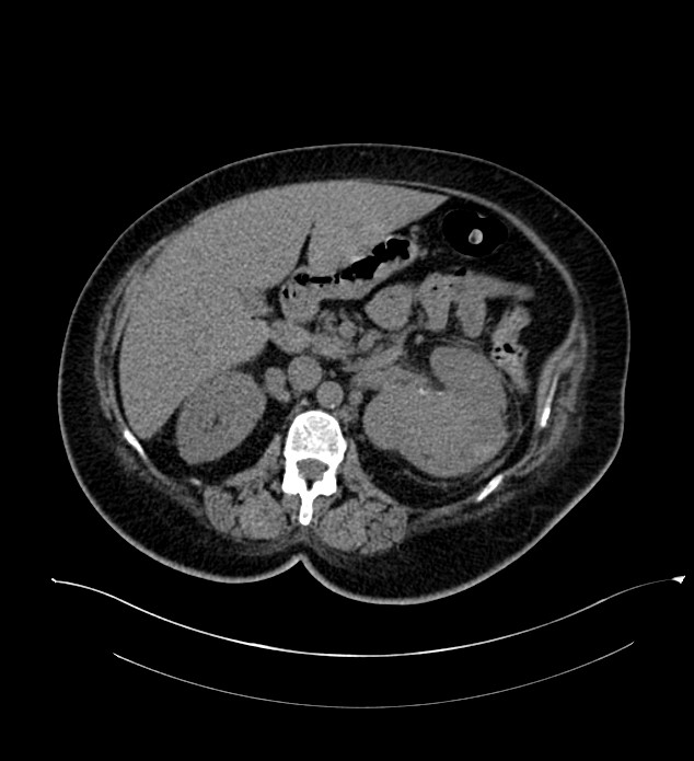 Chromophobe renal cell carcinoma (Radiopaedia 84239-99519 Axial non-contrast 69).jpg