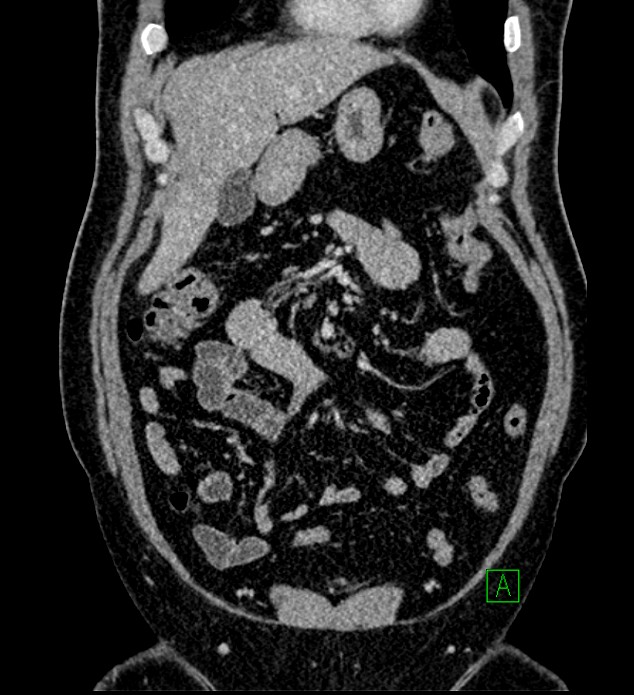 Chromophobe renal cell carcinoma (Radiopaedia 84286-99573 H 52).jpg