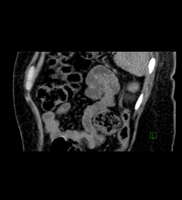 Chromophobe renal cell carcinoma (Radiopaedia 84290-99582 D 18).jpg