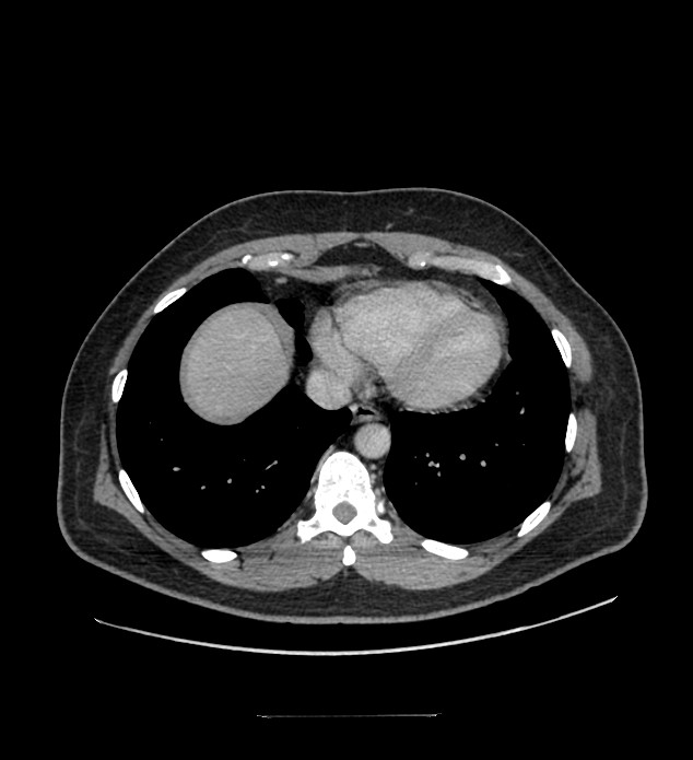 Chromophobe renal cell carcinoma (Radiopaedia 84337-99644 C 11).jpg