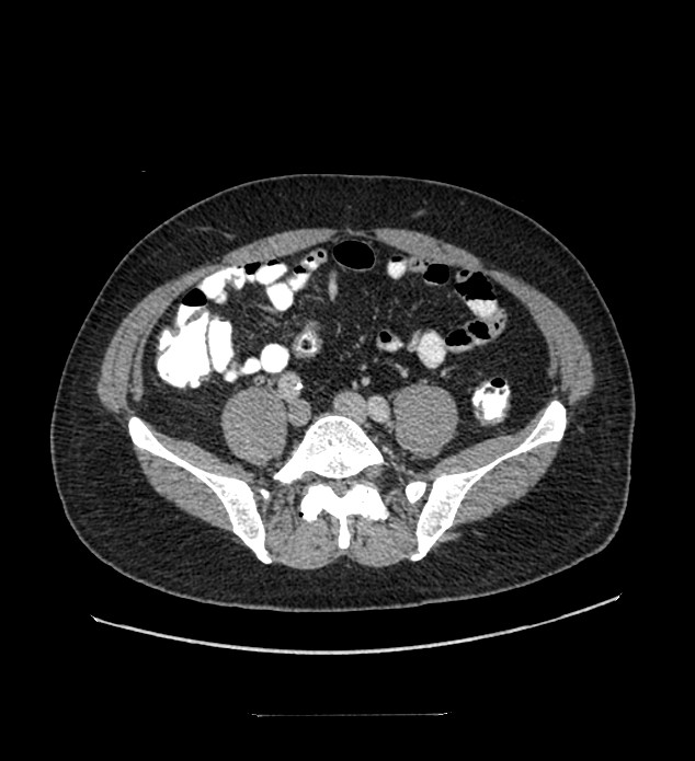 Chromophobe renal cell carcinoma (Radiopaedia 84337-99644 C 92).jpg