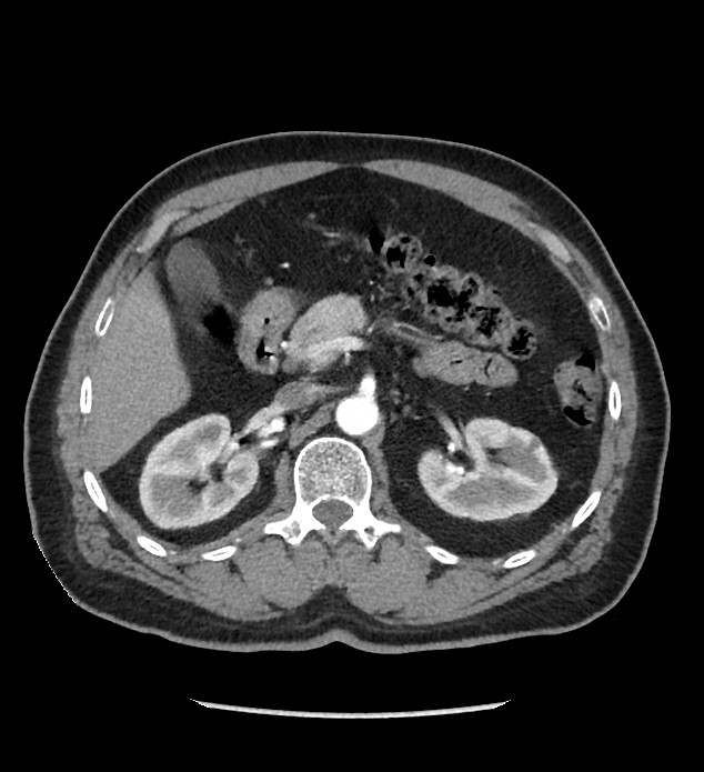 Chromophobe renal cell carcinoma (Radiopaedia 86879-103083 B 50).jpg