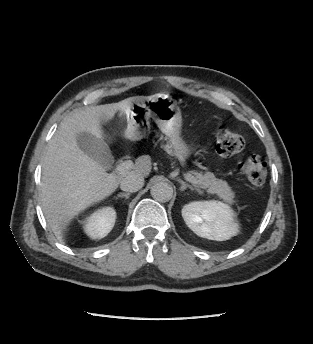 Chromophobe renal cell carcinoma (Radiopaedia 86879-103083 D 36).jpg