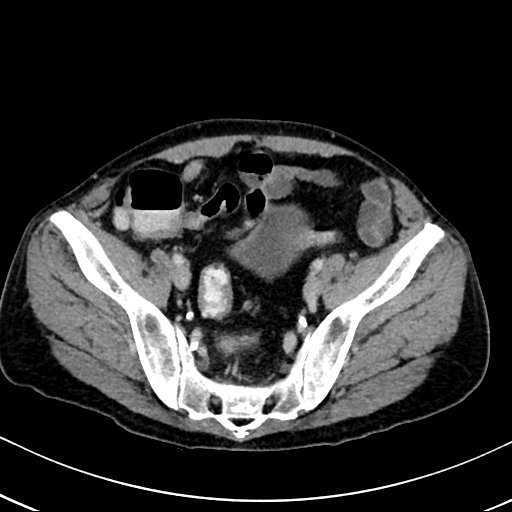 Chronic appendicitis complicated by appendicular abscess, pylephlebitis and liver abscess (Radiopaedia 54483-60700 B 118).jpg