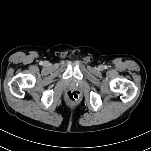 Chronic appendicitis complicated by appendicular abscess, pylephlebitis and liver abscess (Radiopaedia 54483-60700 B 149).jpg