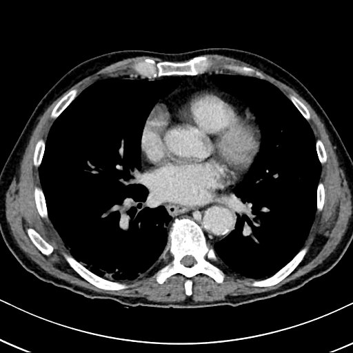 Chronic appendicitis complicated by appendicular abscess, pylephlebitis and liver abscess (Radiopaedia 54483-60700 B 6).jpg