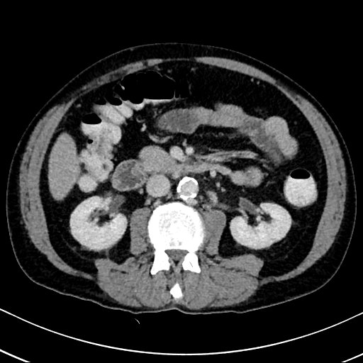Chronic appendicitis complicated by appendicular abscess, pylephlebitis and liver abscess (Radiopaedia 54483-60700 B 73).jpg