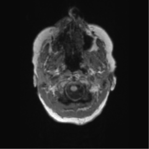 File:Chronic hypertensive encephalopathy (Radiopaedia 72844-83495 Axial T1 68).png