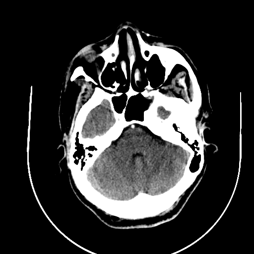 Chronic invasive fungal sinusitis (Radiopaedia 91563-109286 B 22).jpg