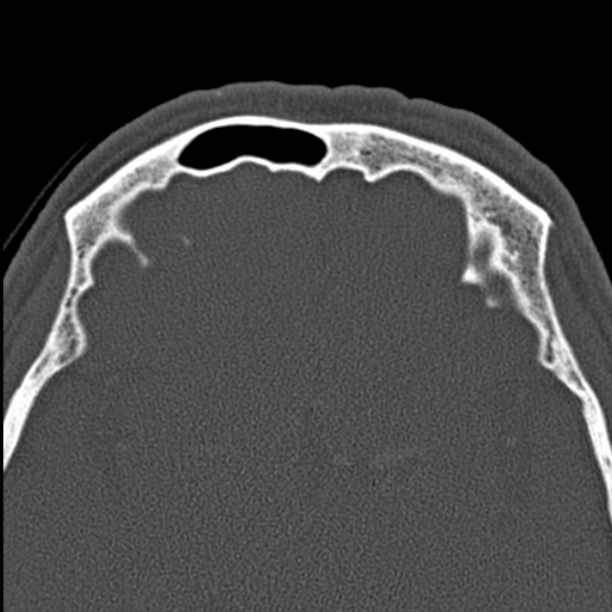 Chronic maxillary sinusitis (Radiopaedia 27879-28116 Axial bone window 48).jpg