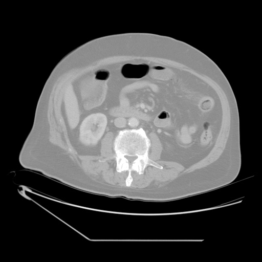 File:Chronic mesenteric ischemia - arterial (Radiopaedia 88205-104810 Axial lung window 13).jpg