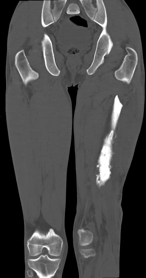 Chronic osteomyelitis (with sequestrum) (Radiopaedia 74813-85822 Coronal non-contrast 36).jpg