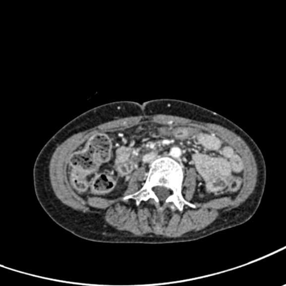 Chronic pancreatitis (Radiopaedia 55405-61846 A 55).jpg