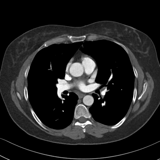 File:Chronic pulmonary embolus (Radiopaedia 39129-41341 Axial C+ CTPA 53).png