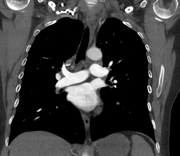 File:Chronic pulmonary embolus (Radiopaedia 39129-41341 Coronal C+ CTPA 47).png