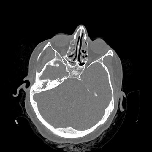 Chronic sinusitis with intra-sinus calcification (Radiopaedia 63919-72668 Axial bone window 22).jpg
