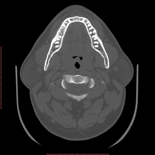 Chronic submandibular sialolithiasis (Radiopaedia 69817-79814 Axial bone window 46).jpg