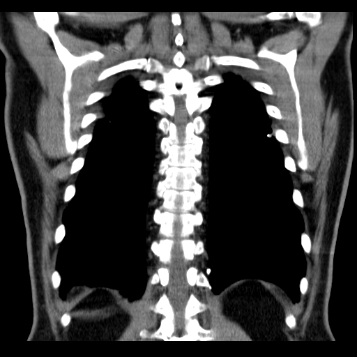 File:Classic complicated silicosis (Radiopaedia 49720-54961 Coronal liver window 51).jpg